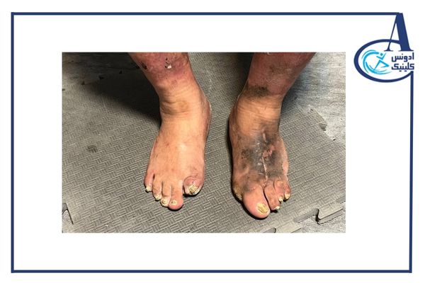 پای دیابتی-ادونس کلینیک